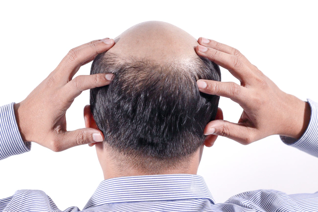 Haarausfall bei Senioren 1